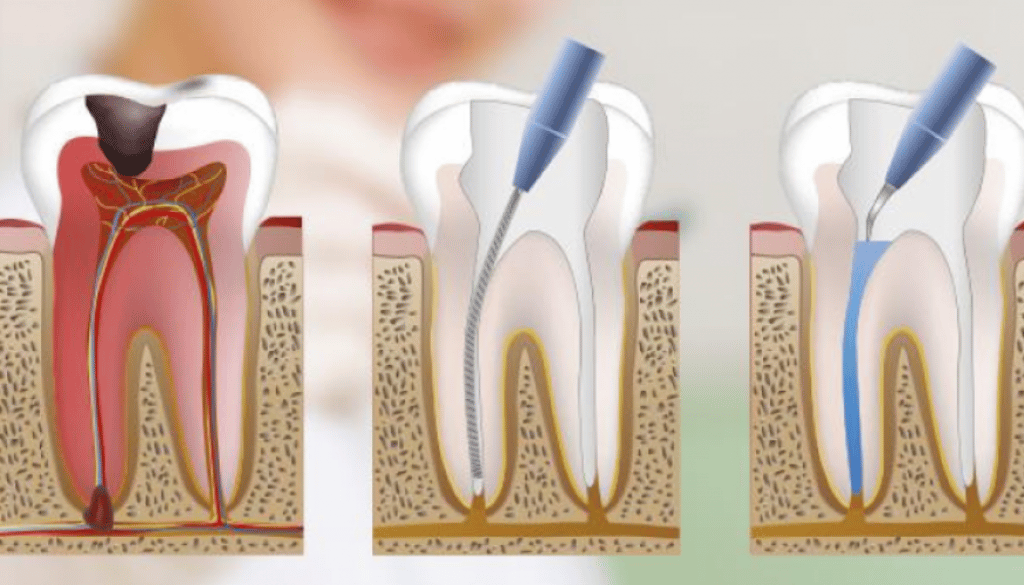 endodonzia devitalizzazione dente clinica del sorriso ferrara